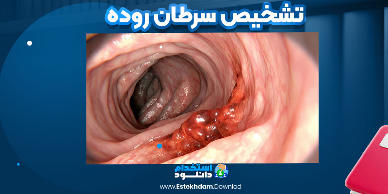 تشخیص سرطان روده